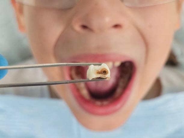 Best Emergency Dentist for Lost Fillings or Crowns in Helemano, HI